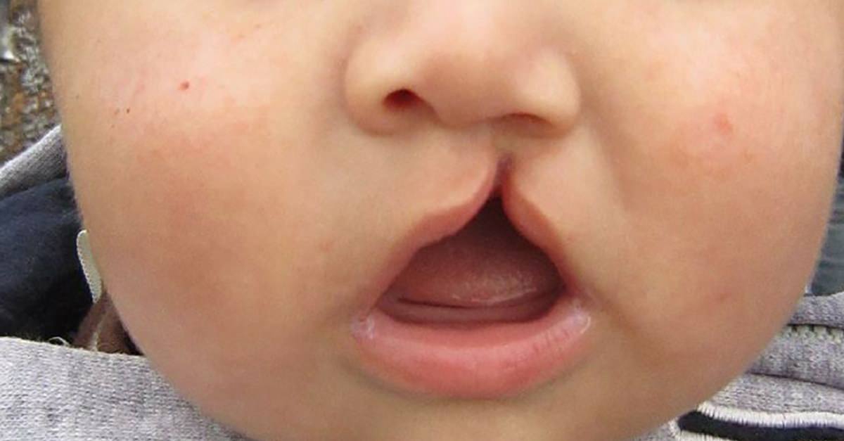 Lula sanciona lei que obriga cirurgia de lábio leporino pelo SUS