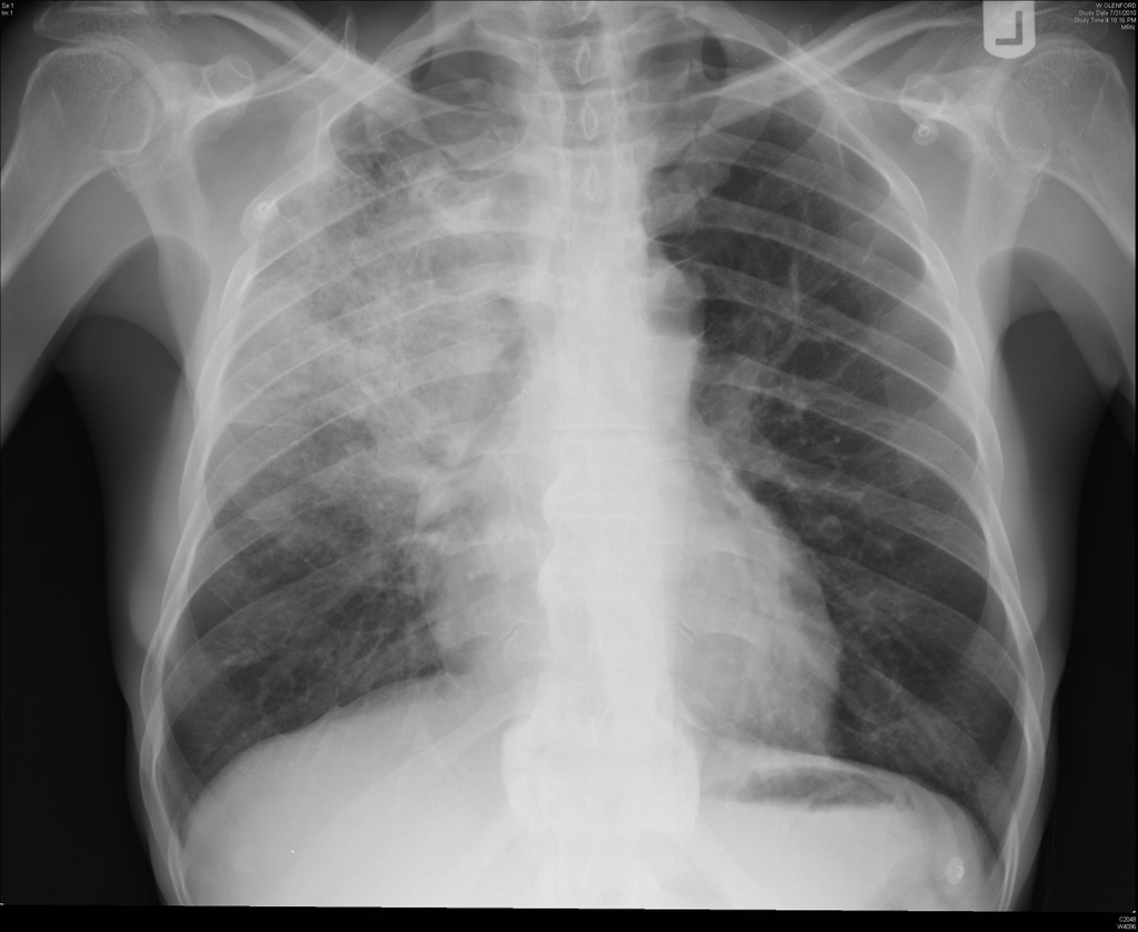 Dia Mundial: Pneumonia é considerada a principal causa de morte de crianças no país