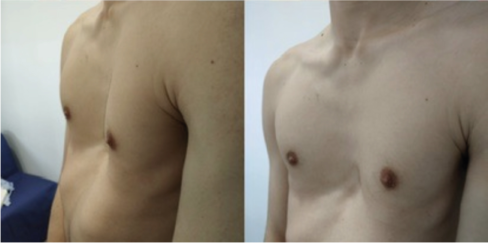 Com doença do tórax afundado adolescente tem esperança de cirurgia gratuita