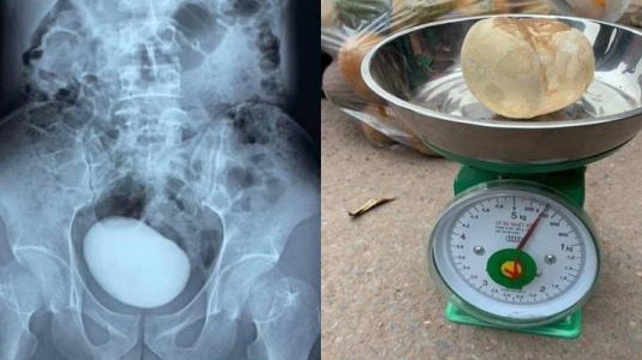 Ao sentir dores abdominais mulher descobre pedra de quase meio quilo na bexiga