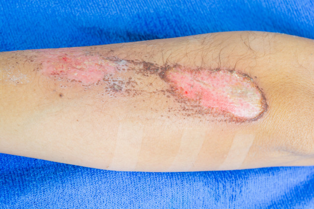 Lesão de continuidade na pele pode ser porta de entrada para bactérias