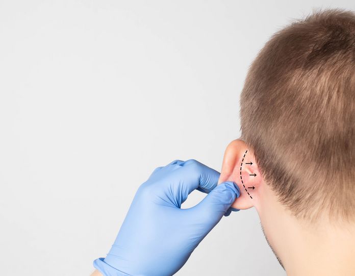 EarBlip, técnica inovadora que permite correção de orelhas abertas sem cirurgia