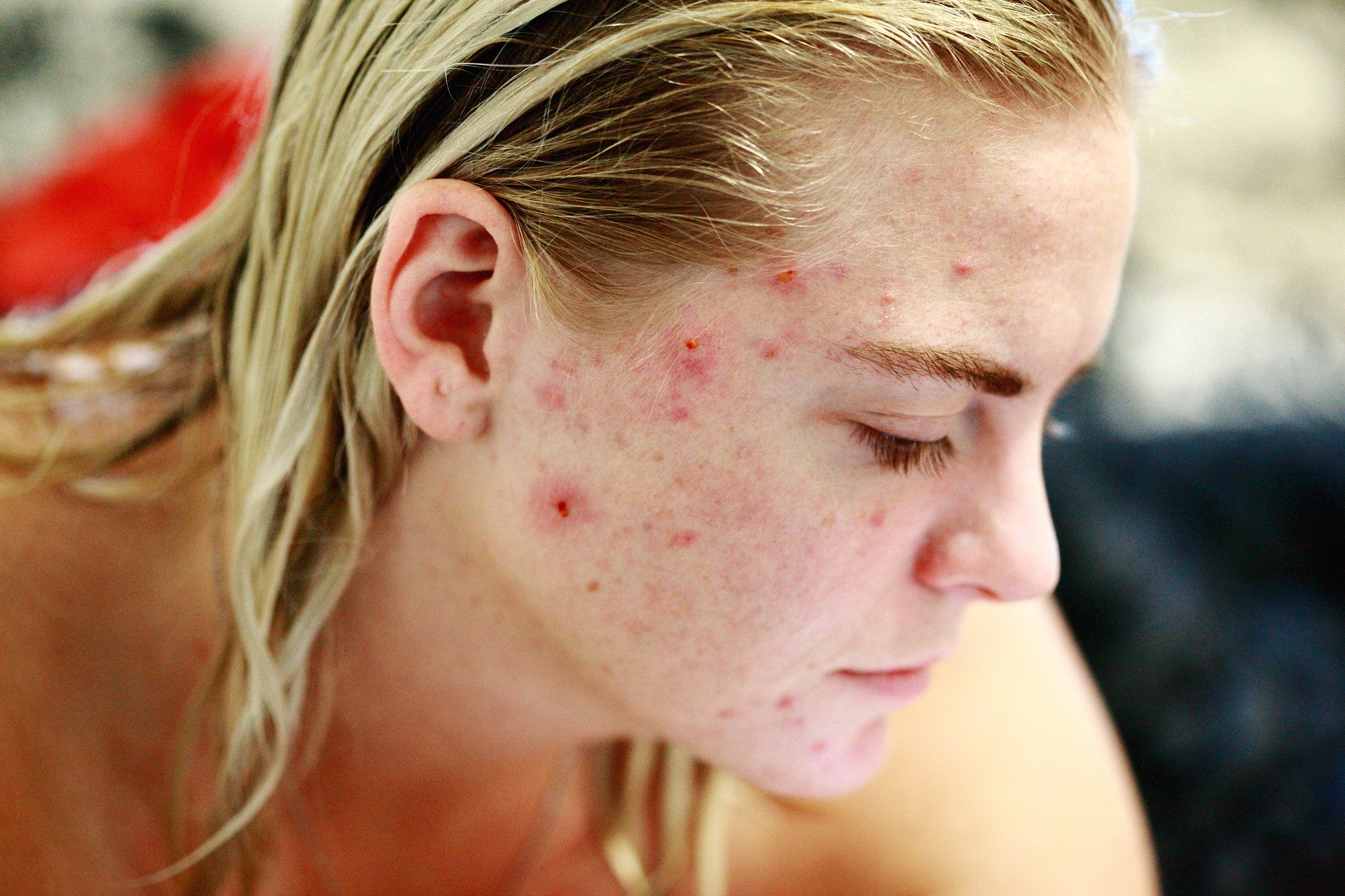 Acne afeta mais de 50% das mulheres adultas e casos crescem com a pandemia