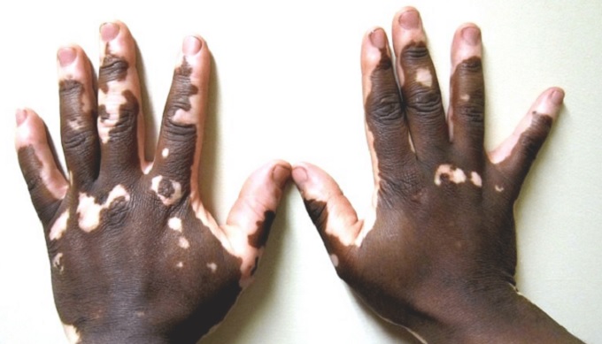 Aluno da UFSB com vitiligo tenta provar que é pardo para se manter em curso de medicina