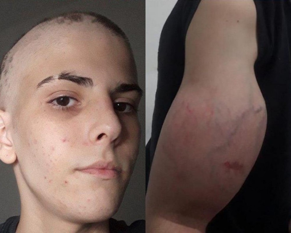 Adolescente descobre câncer e terá que amputar braço deformado após médicos alegarem ‘dor de crescimento’