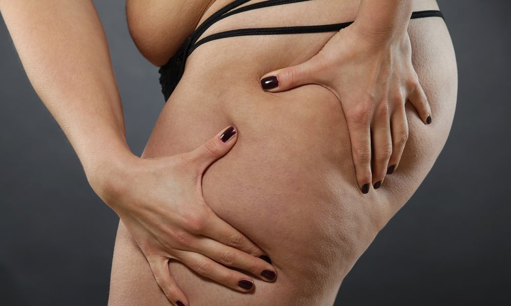 Gordura nos quadris e coxa pode ser sintoma de doença vascular, diz especialista