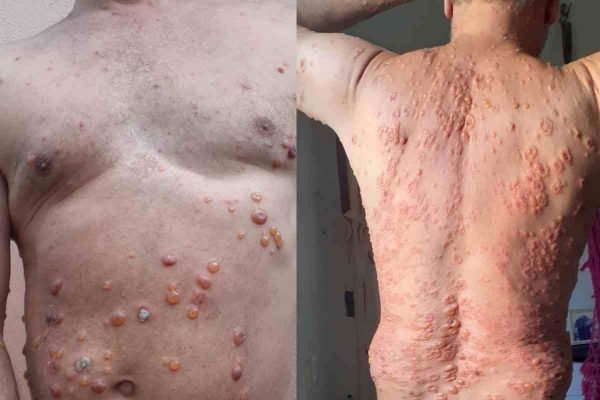 Após pegar Covid, homem desenvolve bolhas por todo o corpo