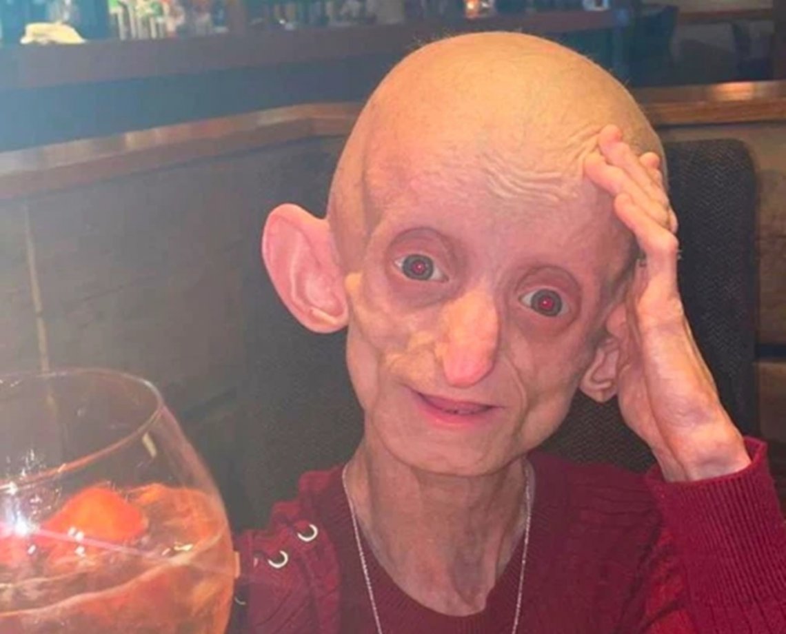 Jovem morre de “velhice” após completar 18 anos. Entenda;