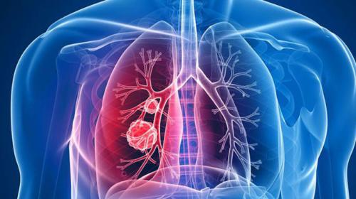 Estudo usa Inteligência Artificial para detecção de nódulos cancerígenos