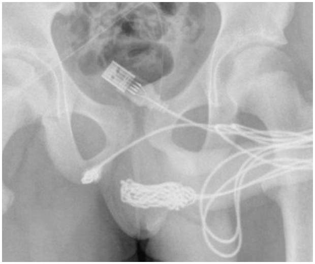 Jovem insere cabo USB no pênis para medir órgão e passa por cirurgia