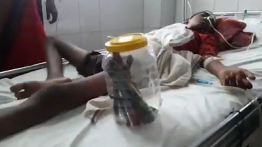 Jovem é operado após engolir 16 escovas de dente e 1 prego