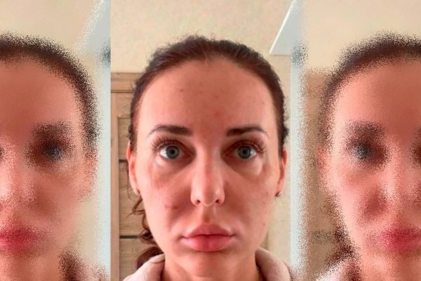Mulher usa medicamento inédito para beleza e fica com “rosto de múmia”