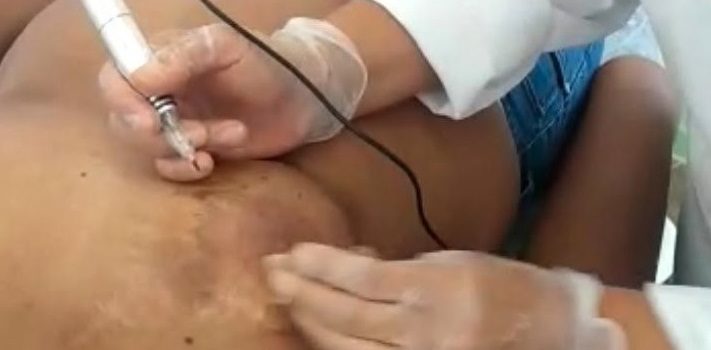 Mulheres podem reconstruir a aréola mamária de graça em Salvador; saiba como