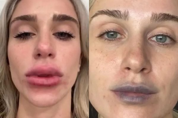 Tiktoker faz preenchimento labial e resultado é desastroso. Veja fotos