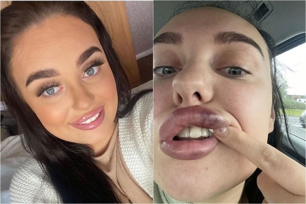Jovem de 21 anos quase perde a visão após fazer preenchimento labial