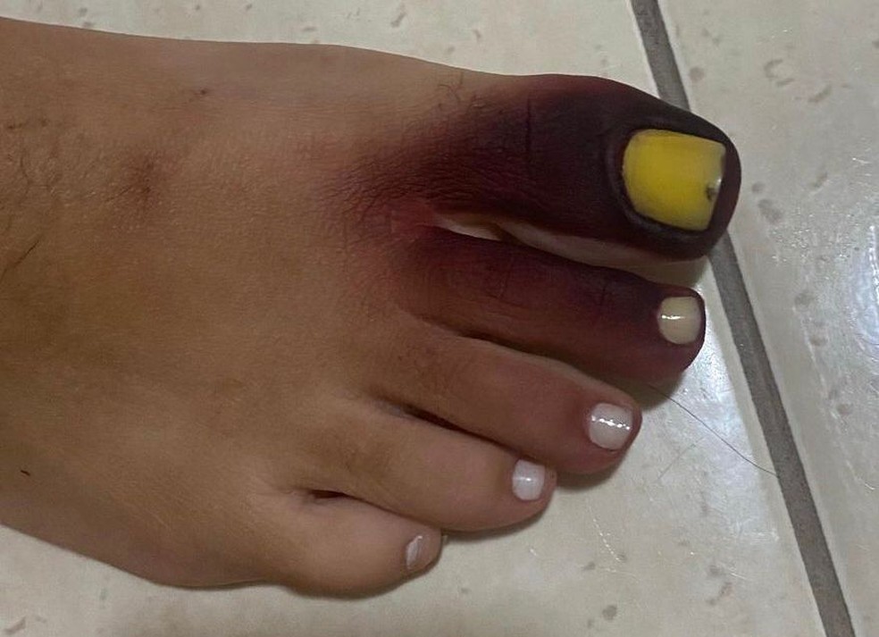 Mulher fica com pé roxo após contato com piolho-de-cobra no tênis