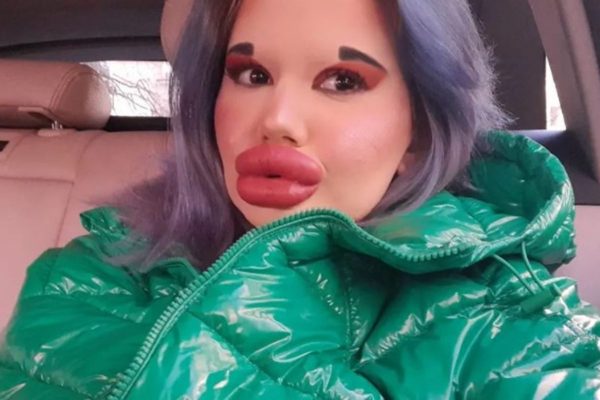 Mulher fará 27º preenchimento labial para se tornar “Bratz humana”