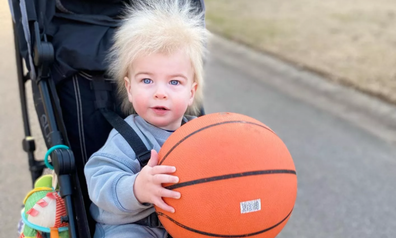 Menino com ‘síndrome do cabelo impenteável’ faz sucesso nas redes sociais