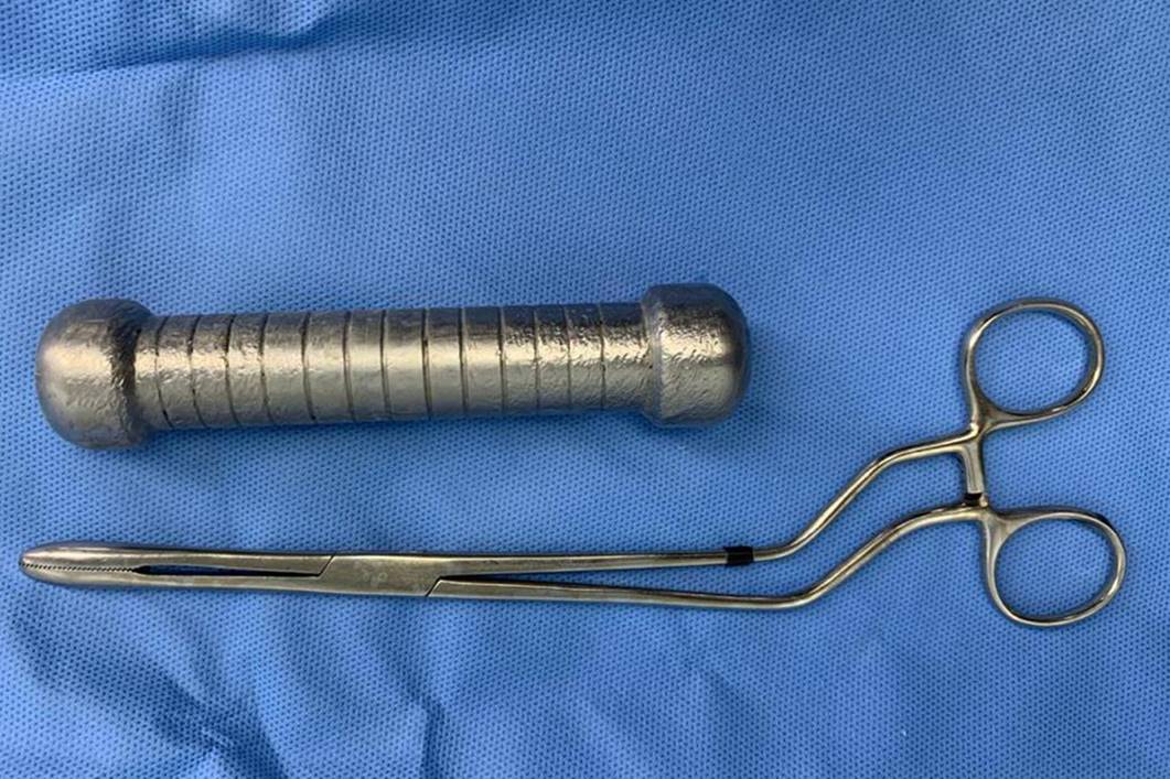 Médicos encontram peso de academia de 2 quilos dentro de paciente