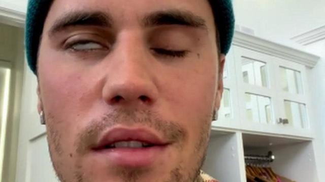 Nova vacina previne contra herpes-zóster e síndrome de Ramsay Hunt