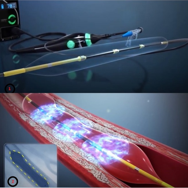 Tecnologia inovadora que desobstrui artéria coronária é usada pela primeira vez na Bahia