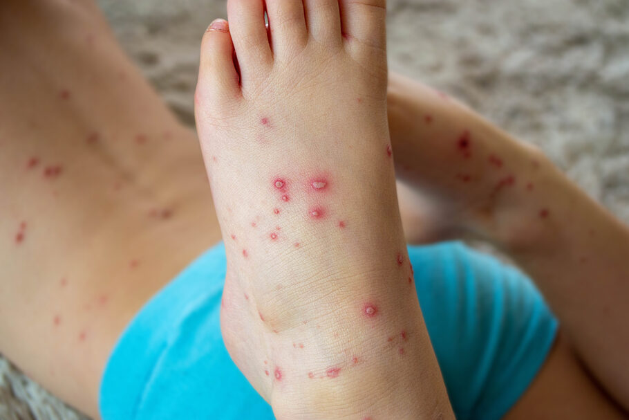 “Gripe do Tomate”: nova doença foi detectada entre crianças e adultos na Índia