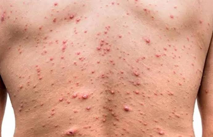 Varíola dos Macacos: mais um caso confirmado em Salvador nesta terça (23)