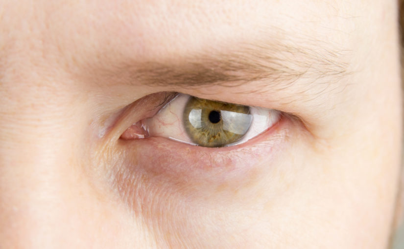 Queda da pálpebra superior dos olhos pode ser congênita ou adquirida, diz especialista