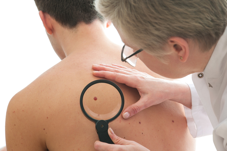 Melanoma Acral: câncer de pele que não pode ser prevenido com filtro solar