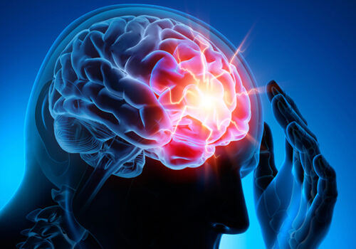 Prevenção de aneurismas cerebrais ainda é pouco conhecida pela população