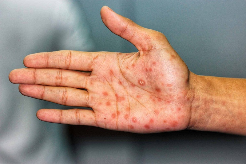 Sífilis: entenda o que é, qual a prevenção e o tratamento disponível no SUS