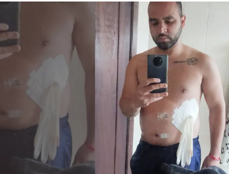 Médico coloca luva cirúrgica no lugar de bolsa de colostomia em paciente