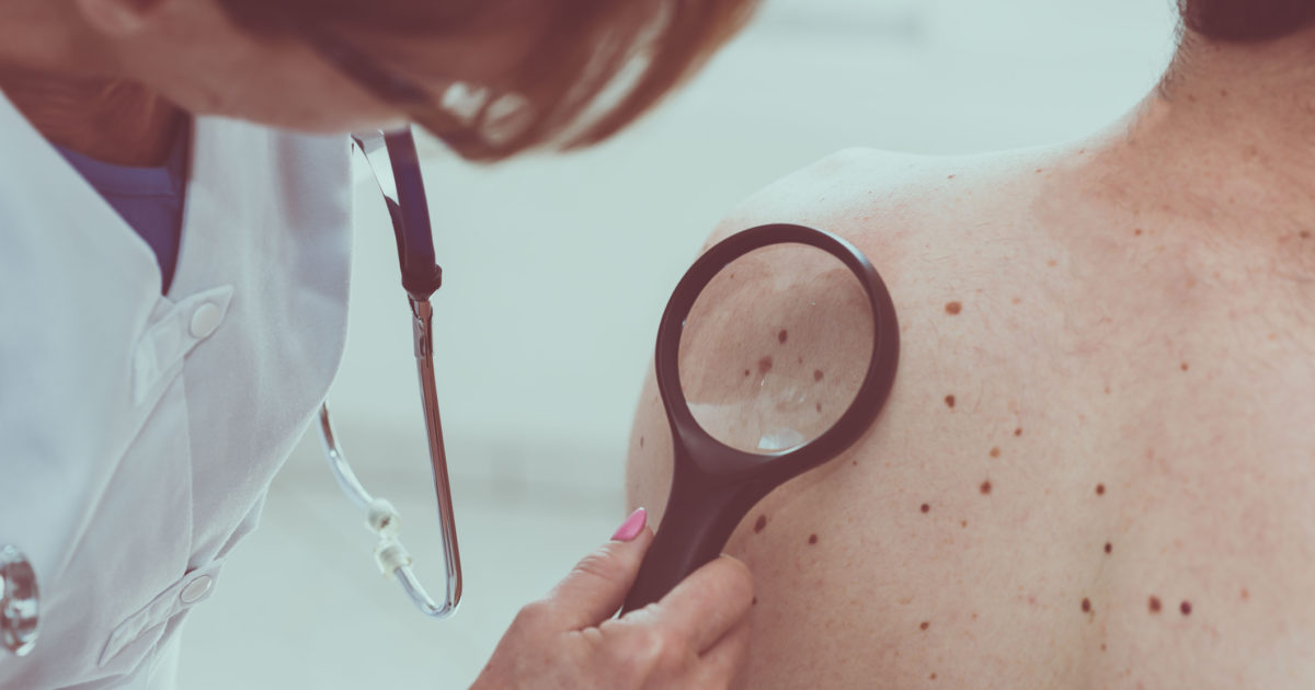 Neste dezembro laranja, SBOC esclarece mitos e verdades sobre o câncer de pele