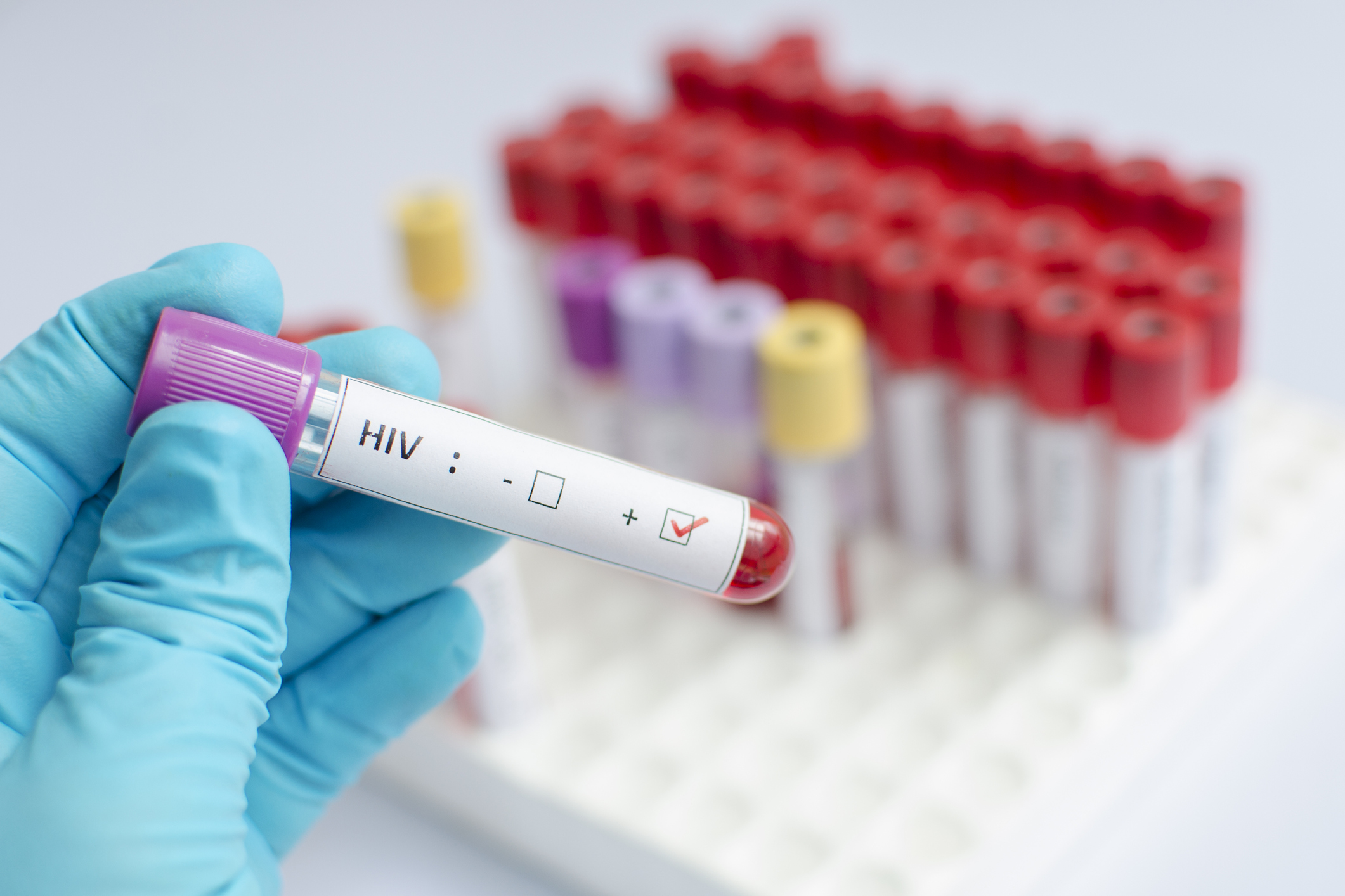 HIV: A importância do acompanhamento psicológico no diagnóstico