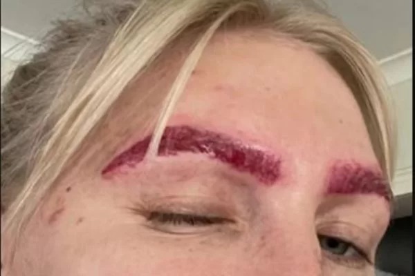 Influenciadora tenta remover micropigmentação e resultado choca internautas