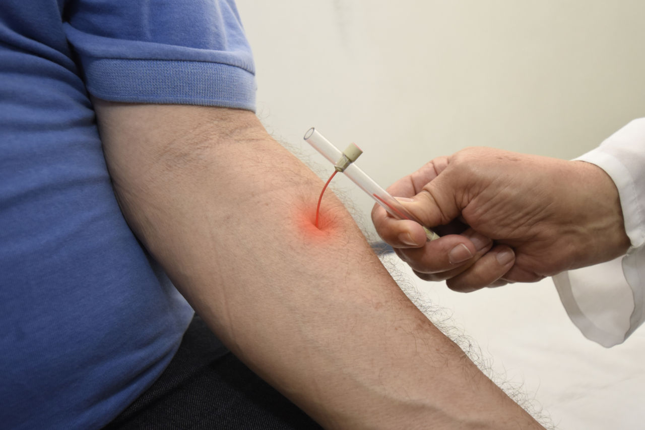 Saúde vai distribuir 150 mil testes rápidos para enfrentamento à hanseníase