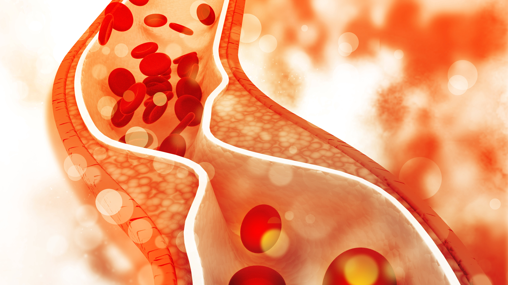 Ataque Isquêmico Transitório pode evoluir para AVC, alertam especialistas