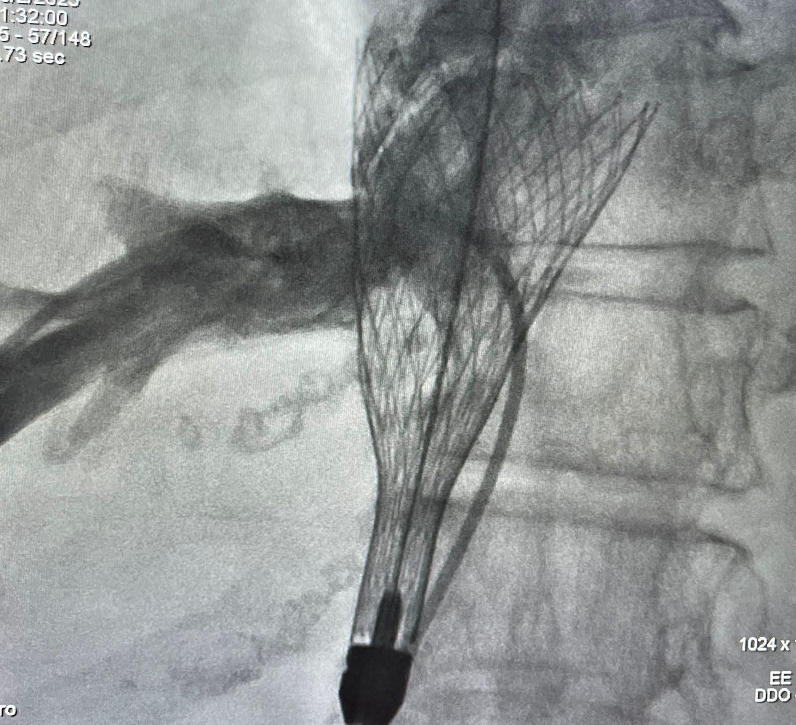 Hospital São Rafael realiza terapia inédita na Bahia para tratamento de válvula do coração