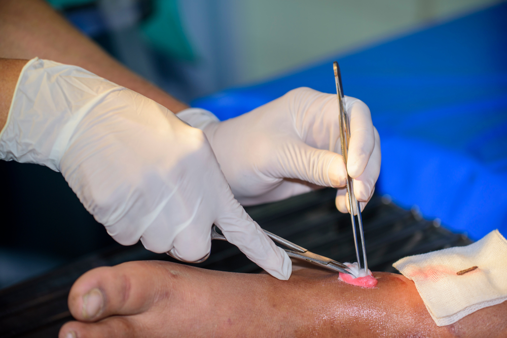 Biocurativo acelera recuperação de lesões na pele em diabéticos tipo 1