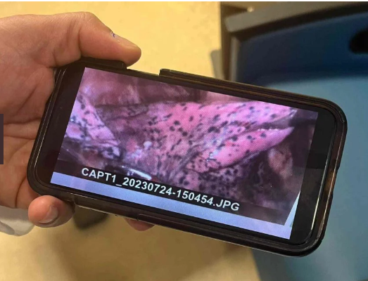 Lutador de 20 anos tem pulmão destruído por uso excessivo de cigarro eletrônico