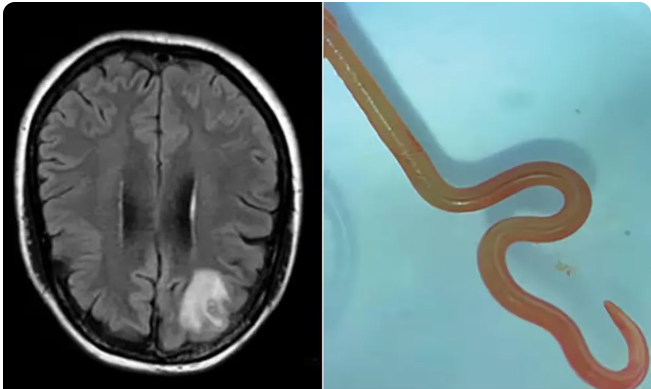 Verme comum em cobras píton é encontrada no cérebro humano pela 1ª vez, aponta estudo