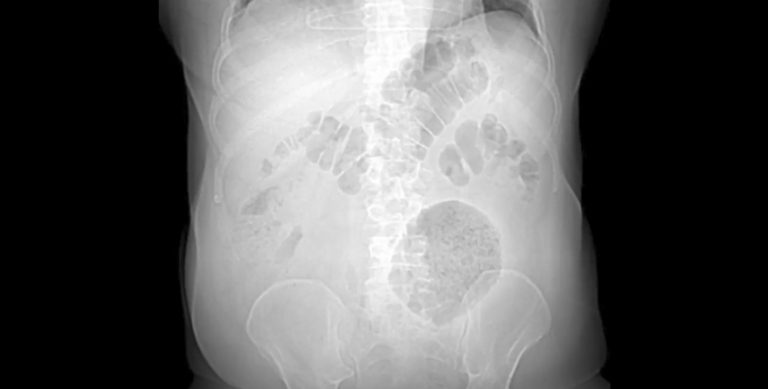 Doença raríssima é identificada em hospital do Rio de Janeiro