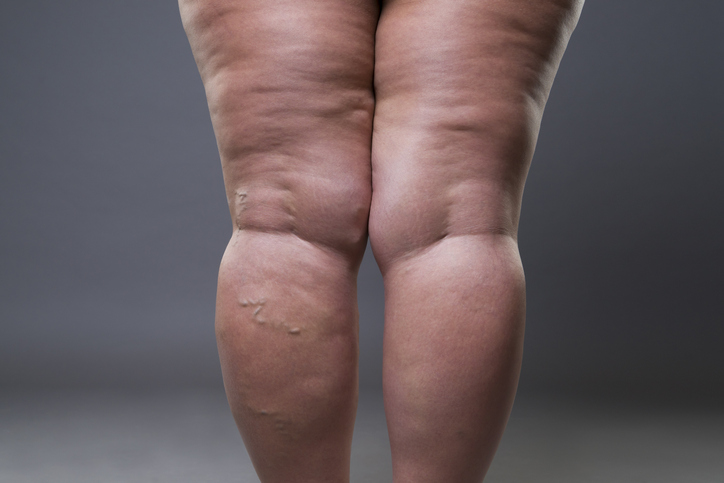 CID da Lipedema na lista da OMS será implementado no Brasil em 2027