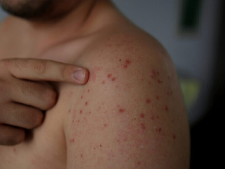 Bahia intensifica vigilância contra sarampo e rubéola com mobilização do Dia “S” de Busca Ativa