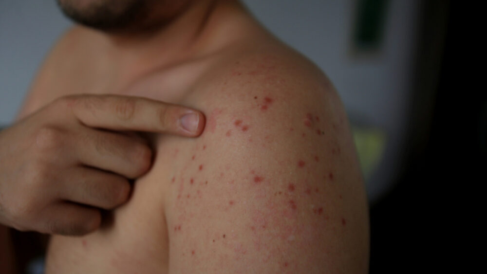 Bahia intensifica vigilância contra sarampo e rubéola com mobilização do Dia “S” de Busca Ativa